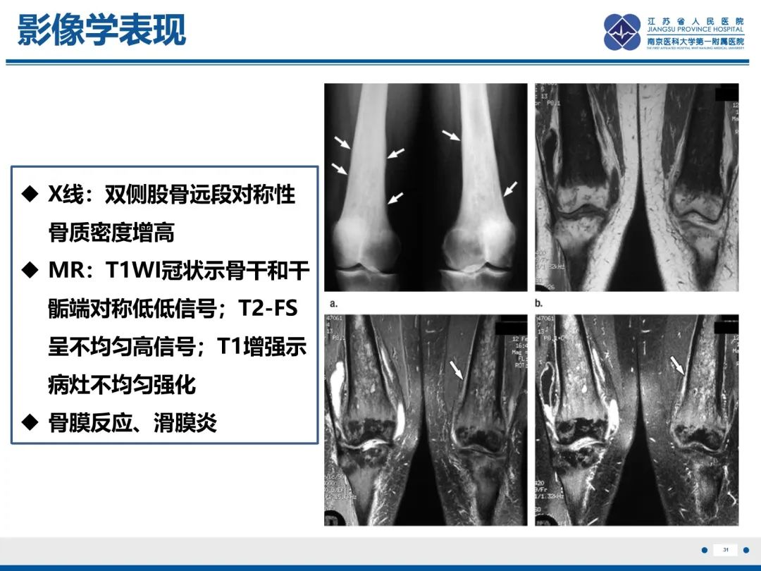 影像PPT - 【PPT】Erdheim-Chester病-32