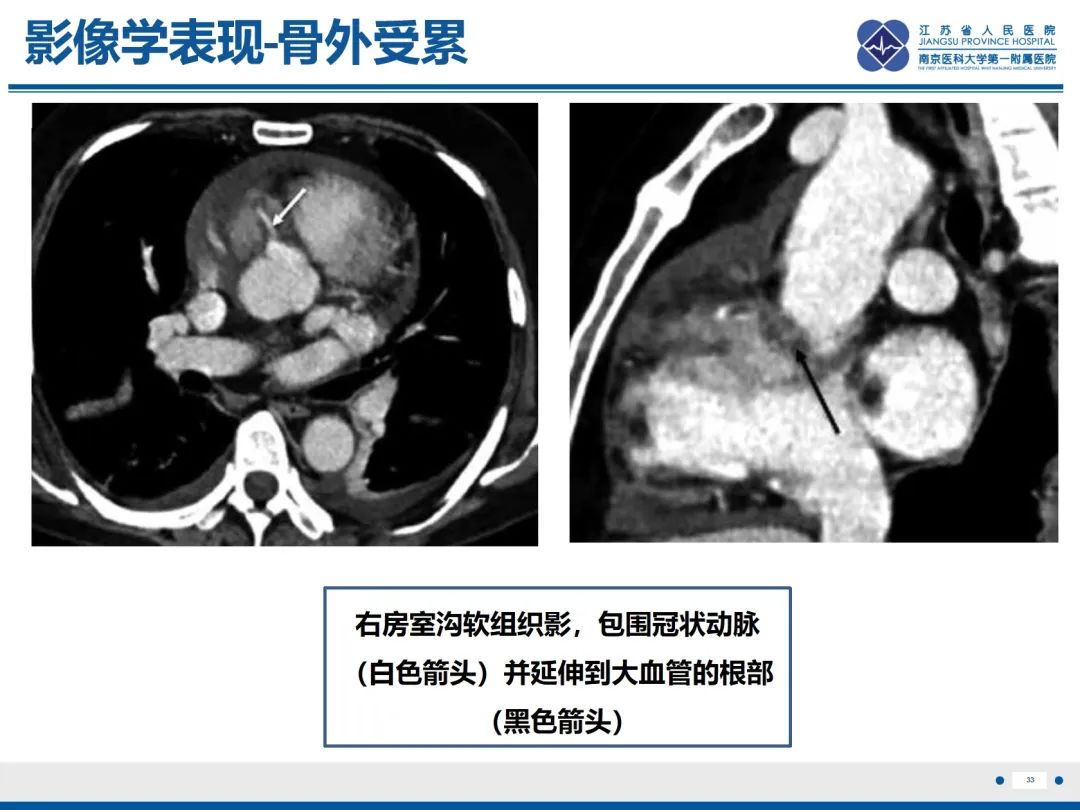 影像PPT - 【PPT】Erdheim-Chester病-34