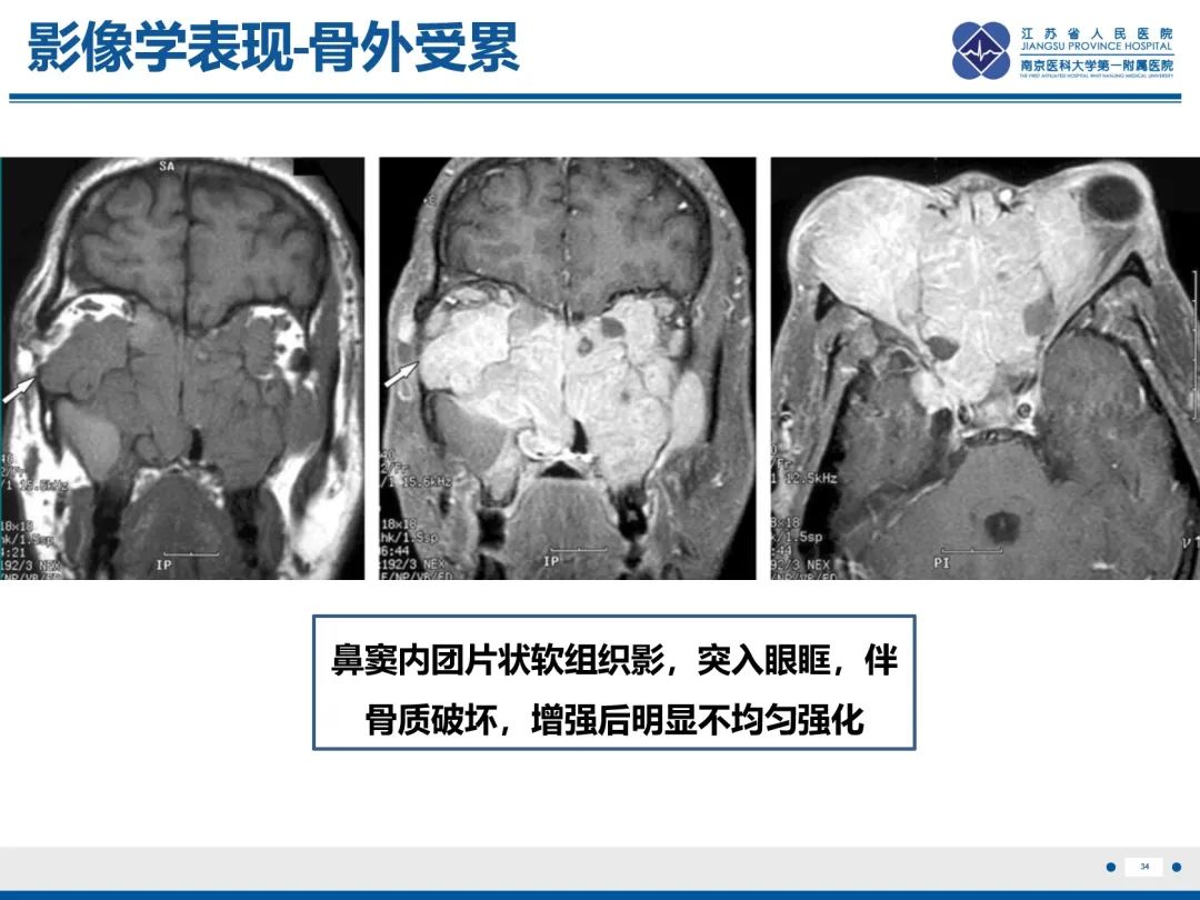 影像PPT - 【PPT】Erdheim-Chester病-35