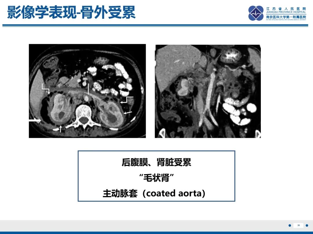 影像PPT - 【PPT】Erdheim-Chester病-36
