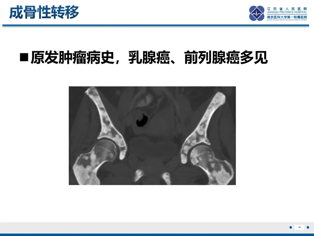 影像PPT - 【PPT】Erdheim-Chester病-45