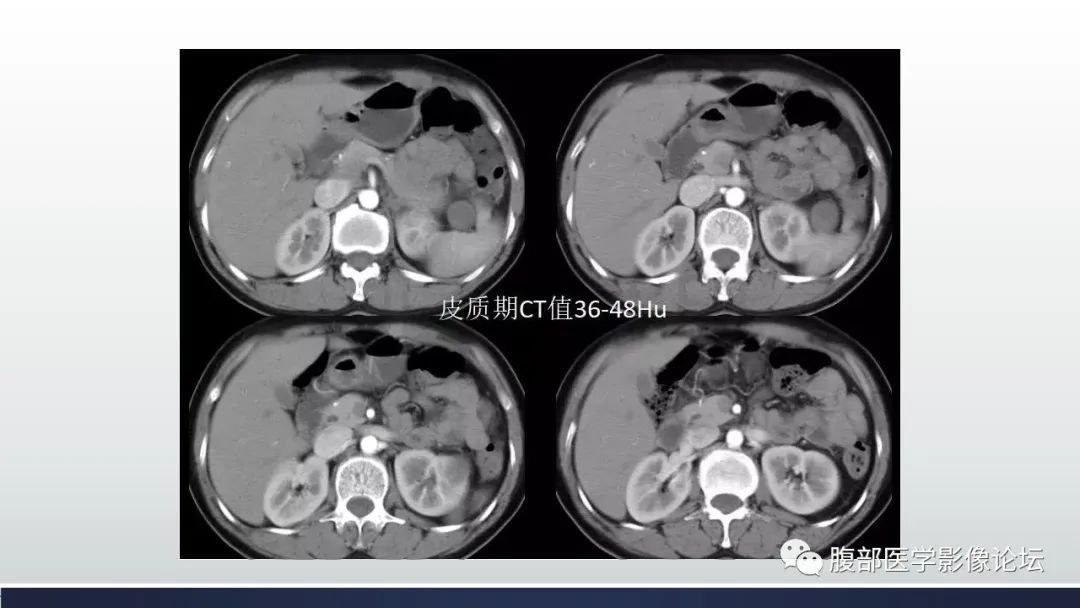 影像PPT - 【病例】肾脏神经鞘瘤1例CT影像-4