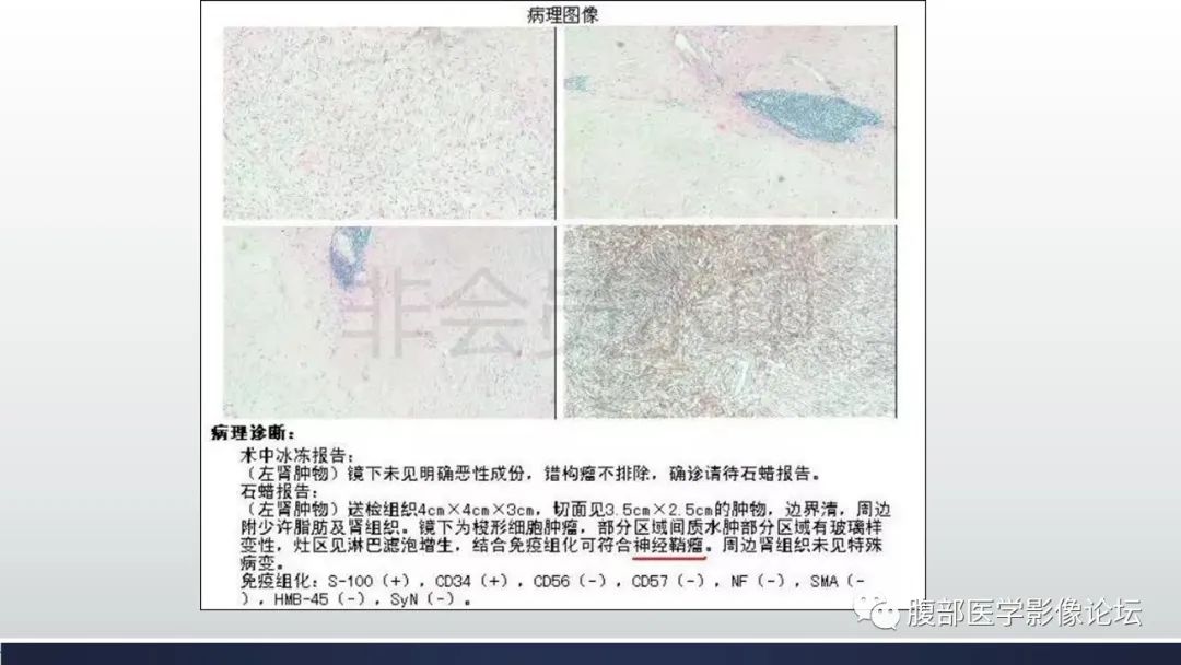 影像PPT - 【病例】肾脏神经鞘瘤1例CT影像-8