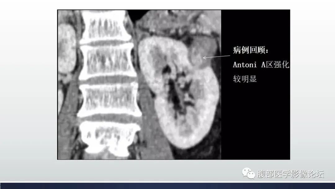 影像PPT - 【病例】肾脏神经鞘瘤1例CT影像-10