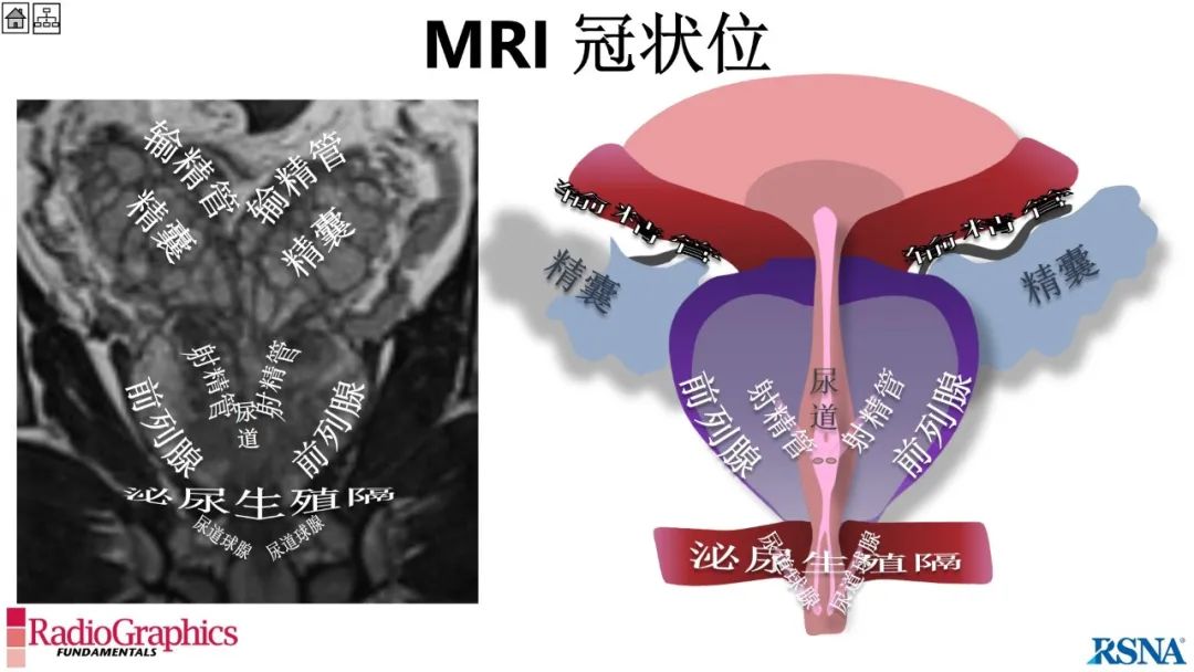 影像PPT - 【PPT】男性盆腔囊肿的影像诊断方法-24
