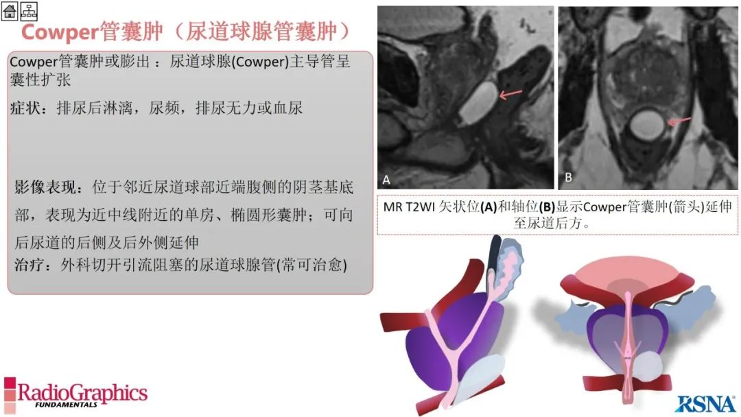 影像PPT - 【PPT】男性盆腔囊肿的影像诊断方法-38