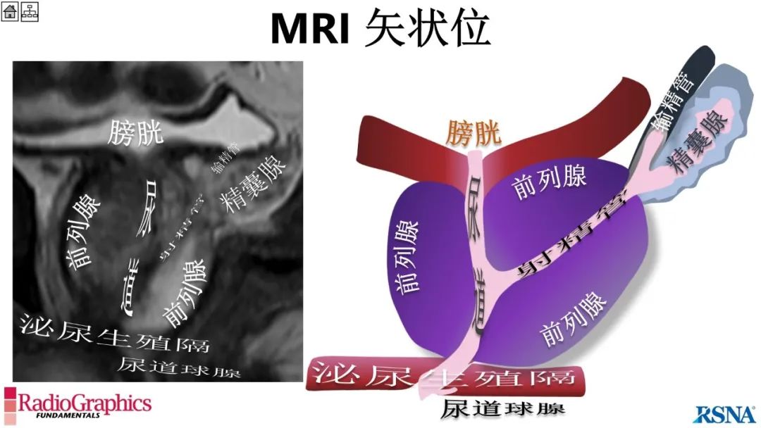 影像PPT - 【PPT】男性盆腔囊肿的影像诊断方法-22