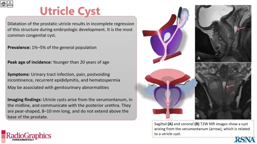 影像PPT - 【PPT】男性盆腔囊肿的影像诊断方法-41