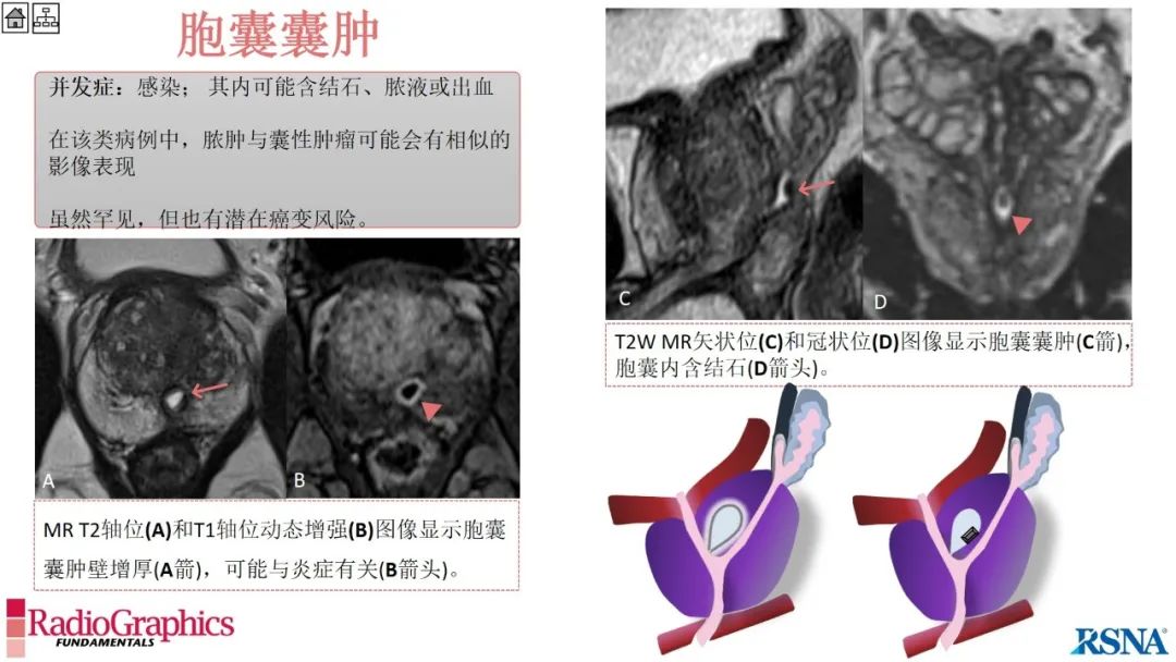 影像PPT - 【PPT】男性盆腔囊肿的影像诊断方法-44