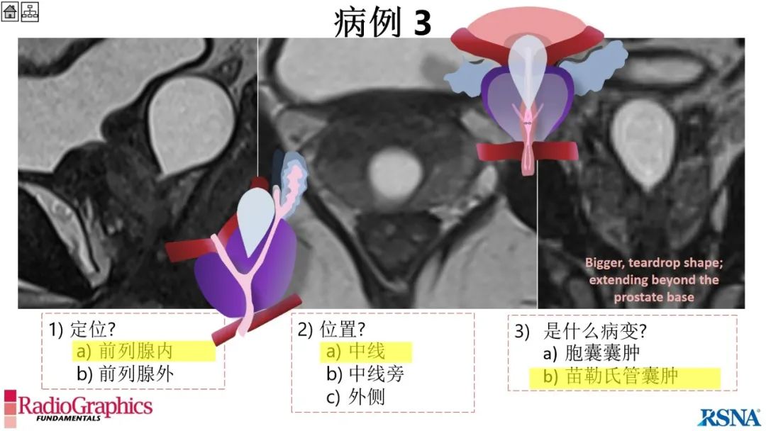 影像PPT - 【PPT】男性盆腔囊肿的影像诊断方法-46