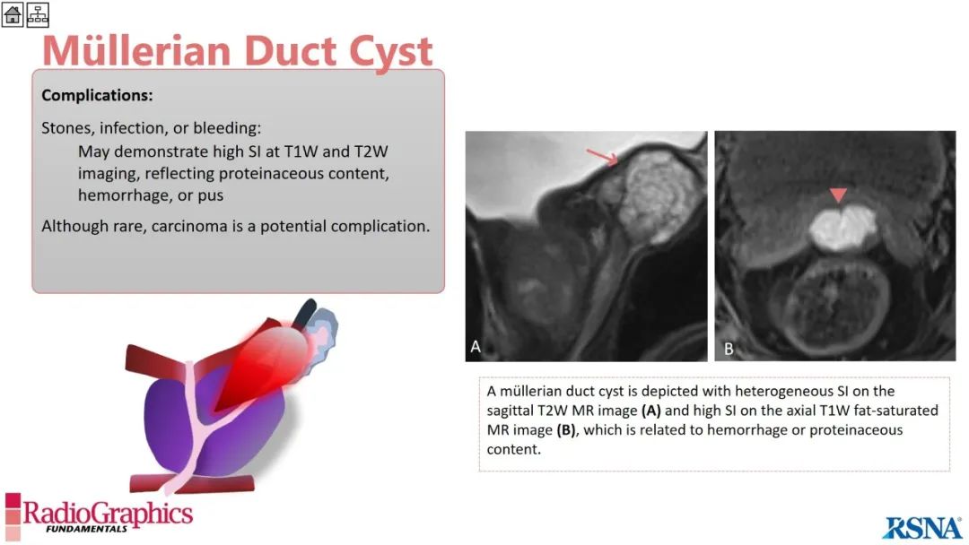 影像PPT - 【PPT】男性盆腔囊肿的影像诊断方法-49