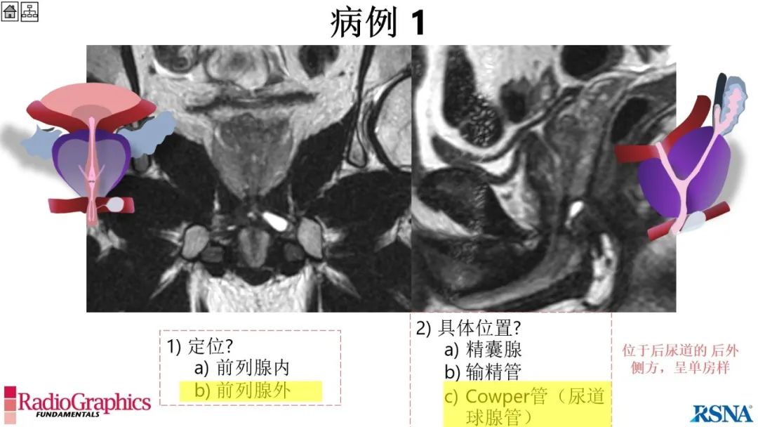 影像PPT - 【PPT】男性盆腔囊肿的影像诊断方法-36