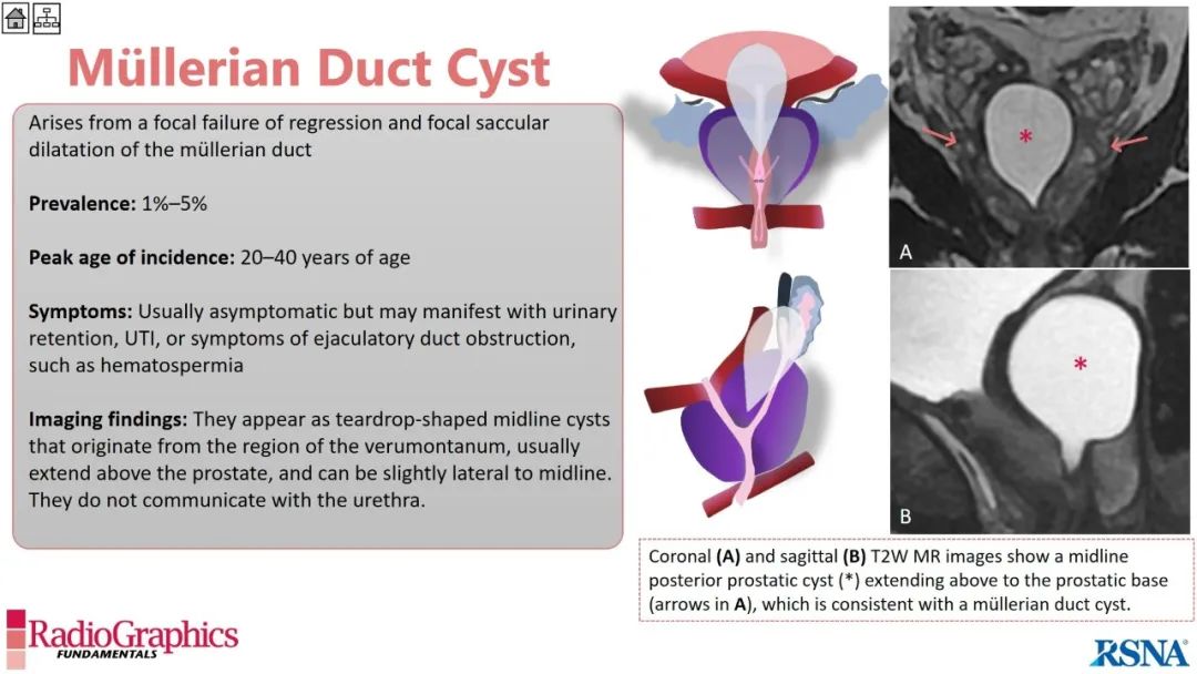 影像PPT - 【PPT】男性盆腔囊肿的影像诊断方法-47