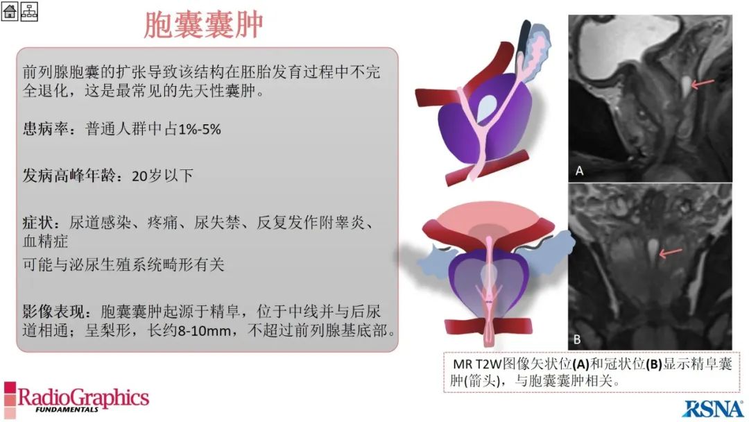 影像PPT - 【PPT】男性盆腔囊肿的影像诊断方法-42