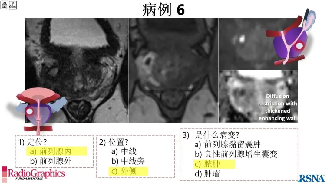 影像PPT - 【PPT】男性盆腔囊肿的影像诊断方法-60