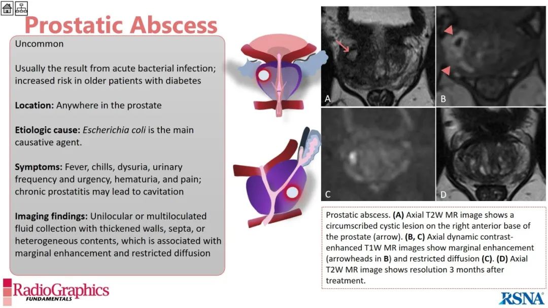 影像PPT - 【PPT】男性盆腔囊肿的影像诊断方法-61