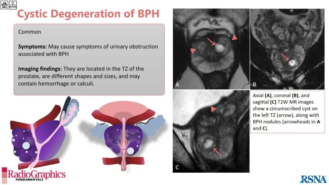 影像PPT - 【PPT】男性盆腔囊肿的影像诊断方法-65