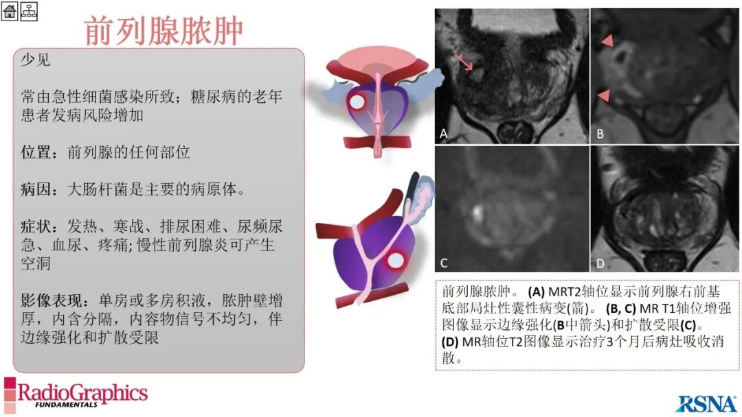 影像PPT - 【PPT】男性盆腔囊肿的影像诊断方法-62