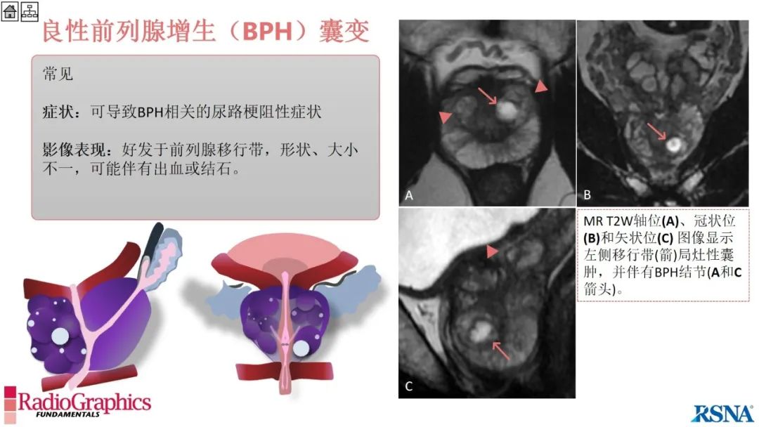 影像PPT - 【PPT】男性盆腔囊肿的影像诊断方法-66