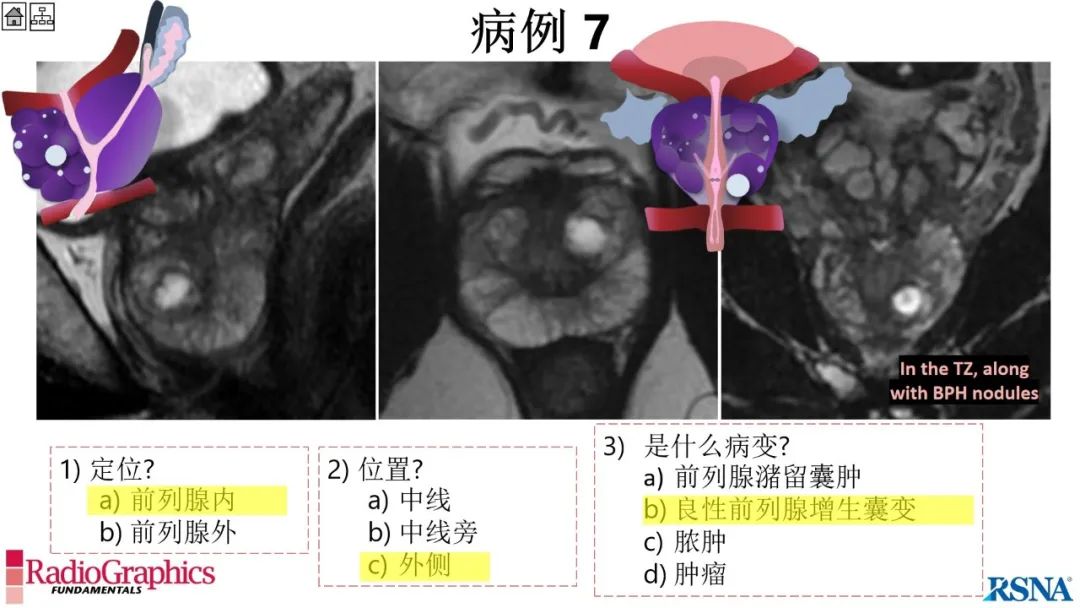 影像PPT - 【PPT】男性盆腔囊肿的影像诊断方法-64