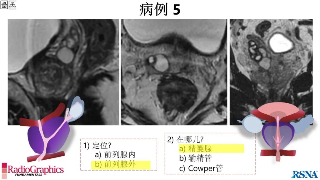 影像PPT - 【PPT】男性盆腔囊肿的影像诊断方法-56