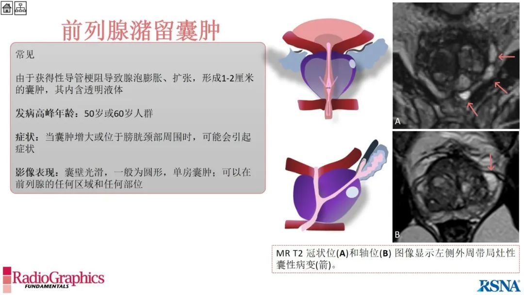 影像PPT - 【PPT】男性盆腔囊肿的影像诊断方法-70