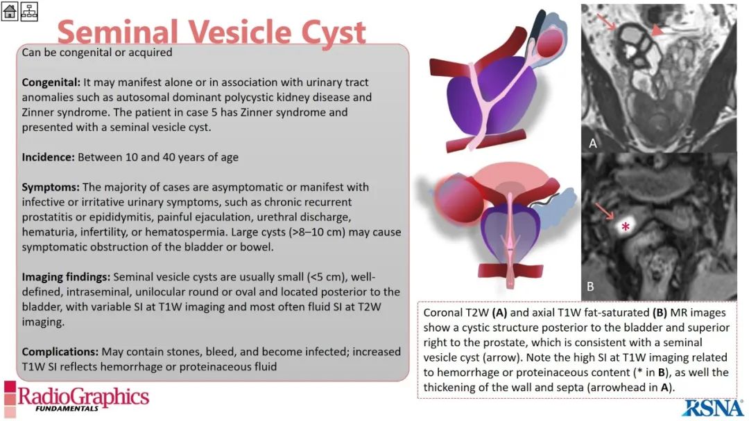 影像PPT - 【PPT】男性盆腔囊肿的影像诊断方法-57