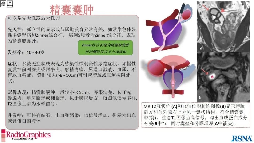 影像PPT - 【PPT】男性盆腔囊肿的影像诊断方法-58