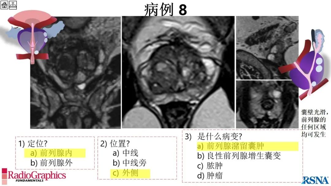 影像PPT - 【PPT】男性盆腔囊肿的影像诊断方法-68