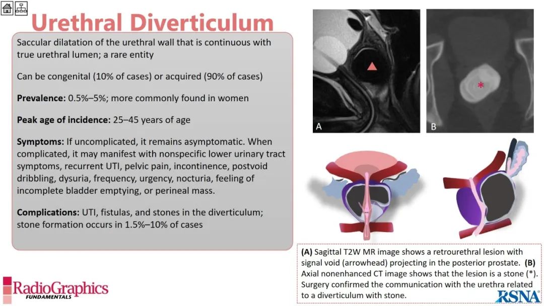 影像PPT - 【PPT】男性盆腔囊肿的影像诊断方法-73