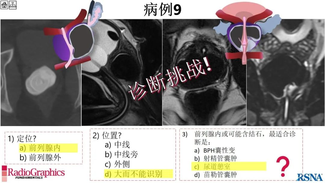 影像PPT - 【PPT】男性盆腔囊肿的影像诊断方法-72
