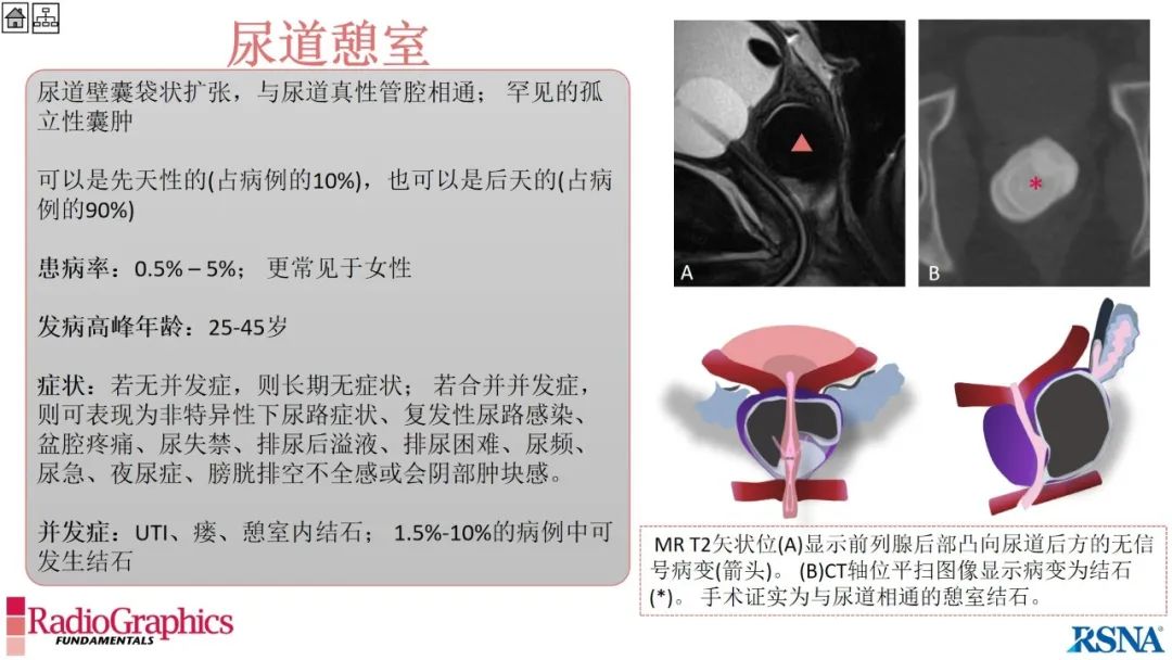 影像PPT - 【PPT】男性盆腔囊肿的影像诊断方法-74