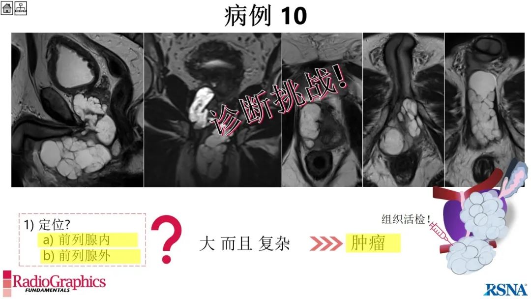 影像PPT - 【PPT】男性盆腔囊肿的影像诊断方法-76
