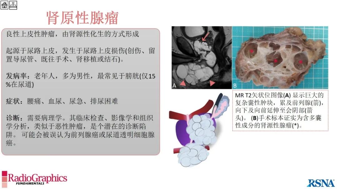 影像PPT - 【PPT】男性盆腔囊肿的影像诊断方法-78