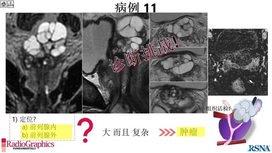 影像PPT - 【PPT】男性盆腔囊肿的影像诊断方法-82