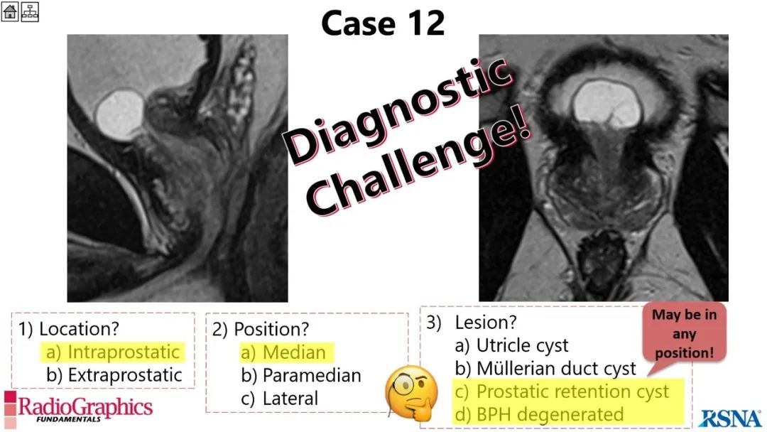 影像PPT - 【PPT】男性盆腔囊肿的影像诊断方法-85
