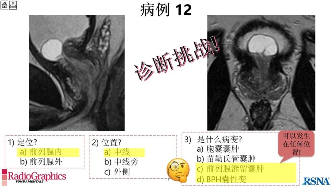 影像PPT - 【PPT】男性盆腔囊肿的影像诊断方法-86