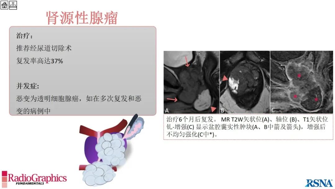 影像PPT - 【PPT】男性盆腔囊肿的影像诊断方法-80