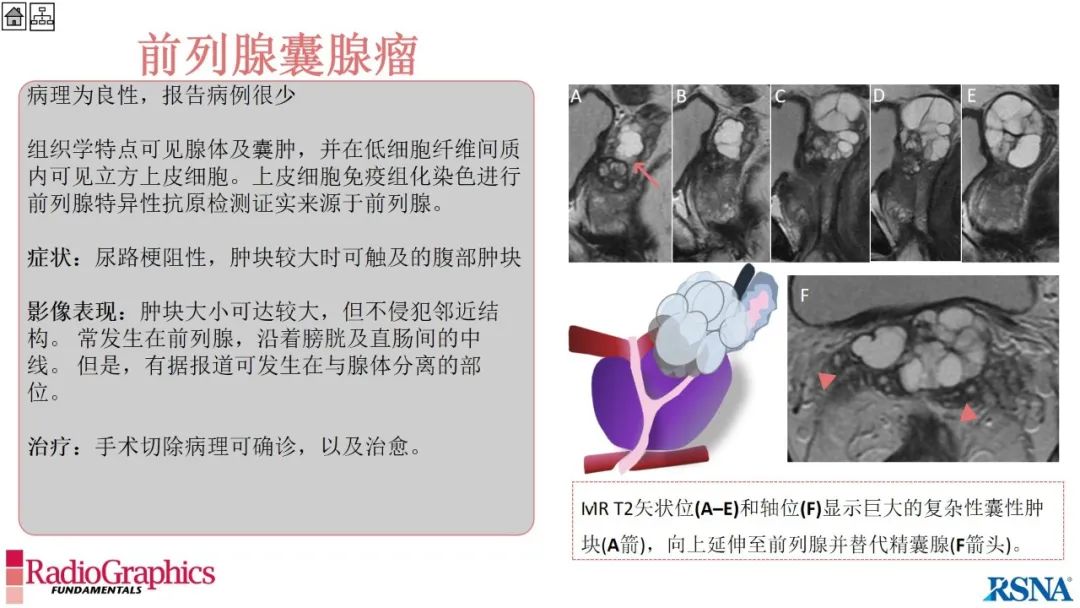 影像PPT - 【PPT】男性盆腔囊肿的影像诊断方法-84