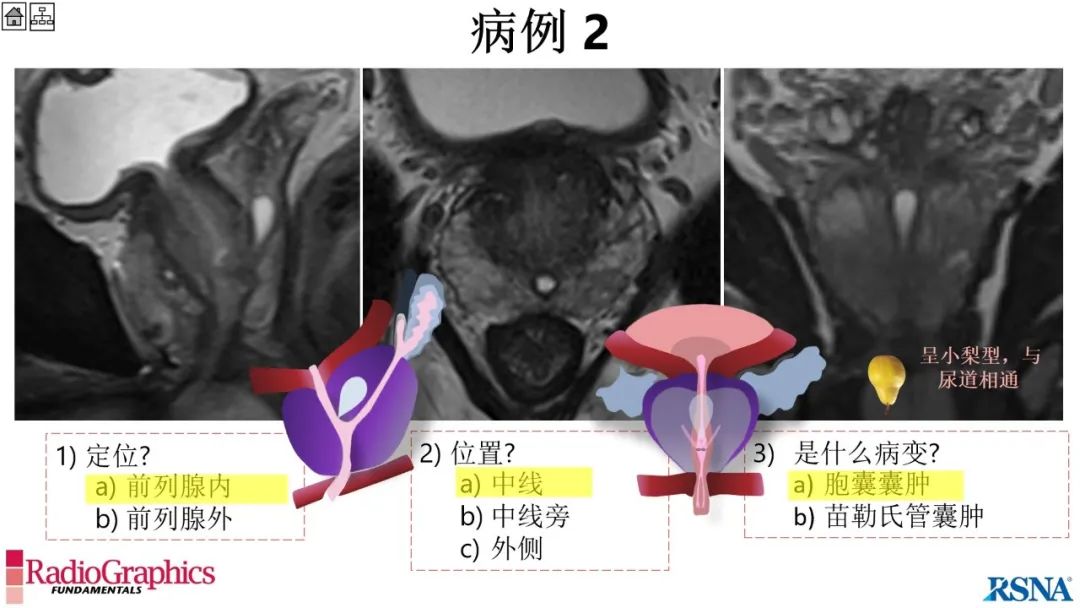 影像PPT - 【PPT】男性盆腔囊肿的影像诊断方法-40