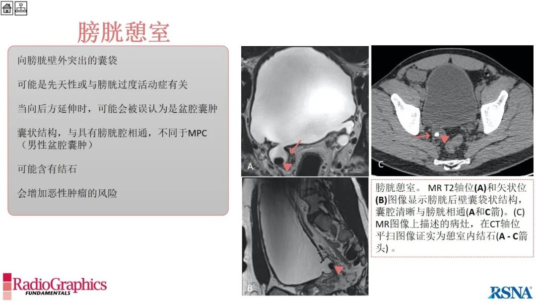 影像PPT - 【PPT】男性盆腔囊肿的影像诊断方法-94