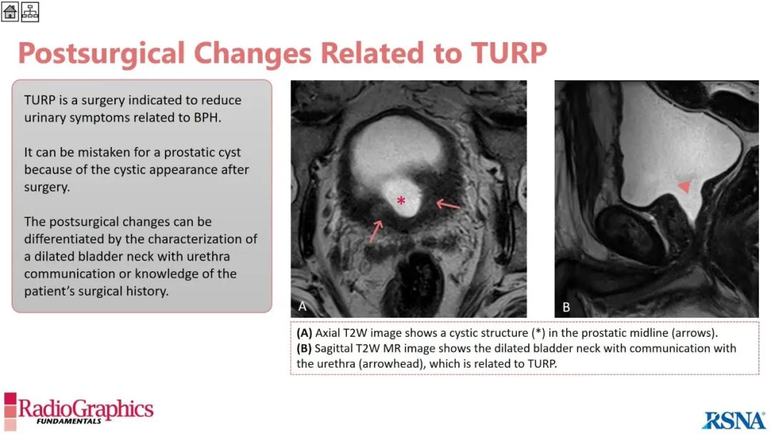 影像PPT - 【PPT】男性盆腔囊肿的影像诊断方法-97