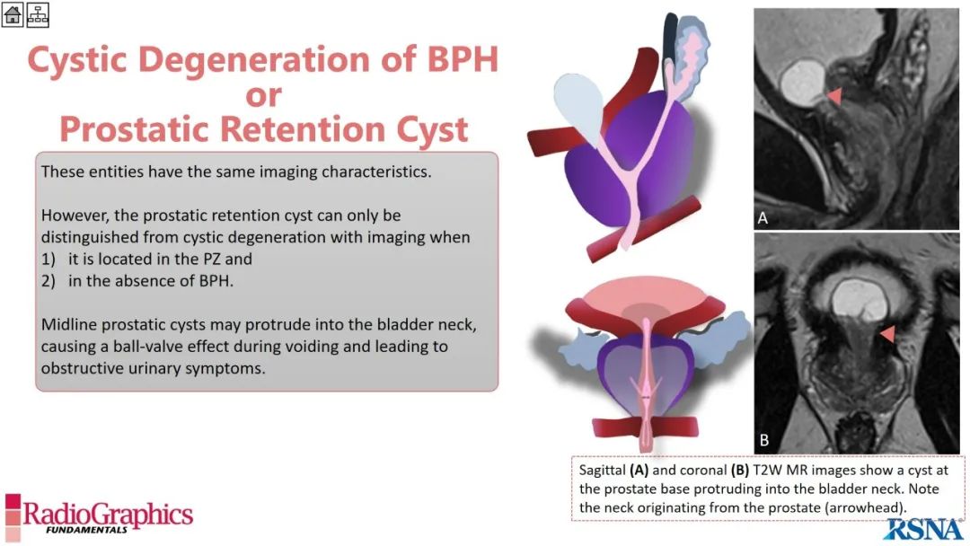 影像PPT - 【PPT】男性盆腔囊肿的影像诊断方法-87