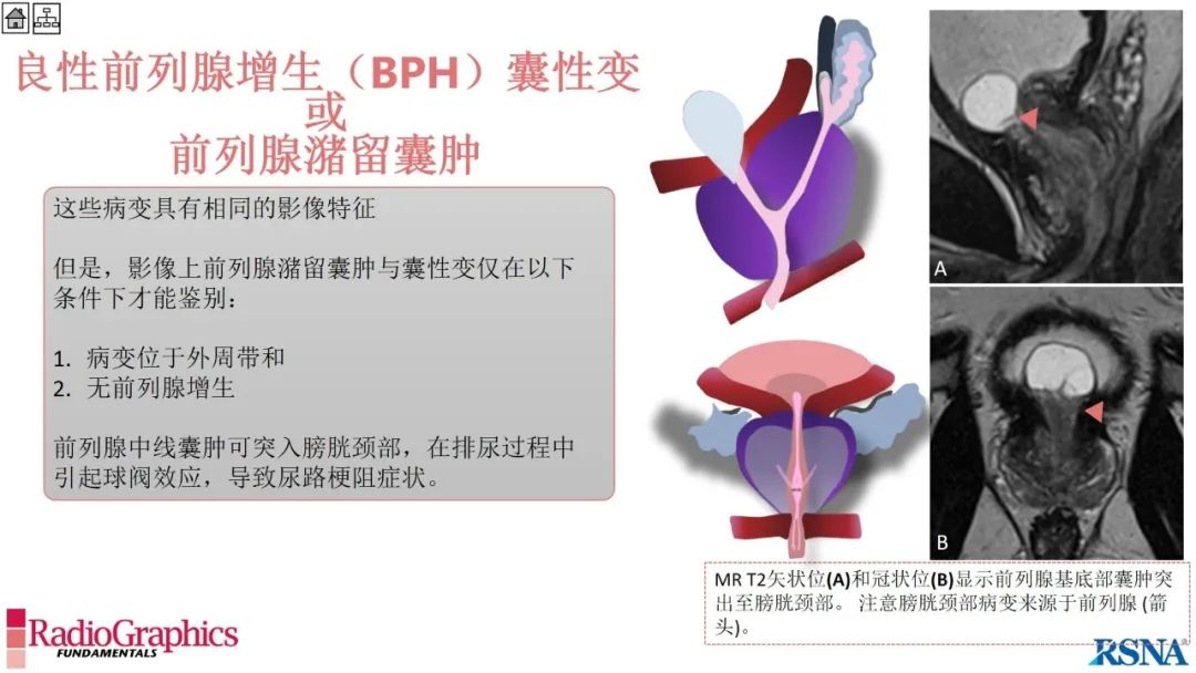 影像PPT - 【PPT】男性盆腔囊肿的影像诊断方法-88
