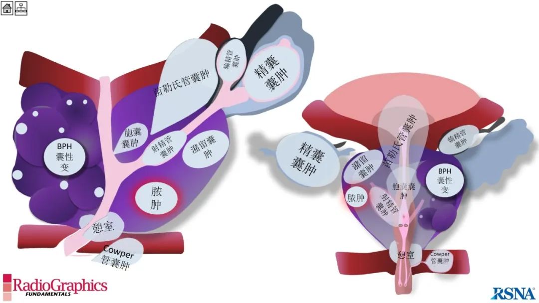 影像PPT - 【PPT】男性盆腔囊肿的影像诊断方法-102