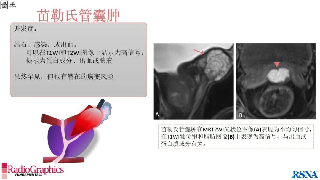 影像PPT - 【PPT】男性盆腔囊肿的影像诊断方法-50