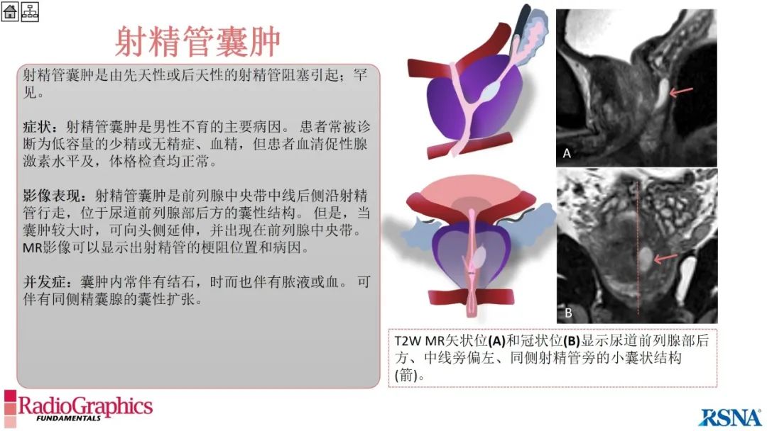 影像PPT - 【PPT】男性盆腔囊肿的影像诊断方法-54