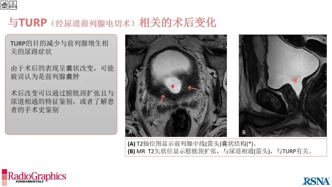 影像PPT - 【PPT】男性盆腔囊肿的影像诊断方法-98