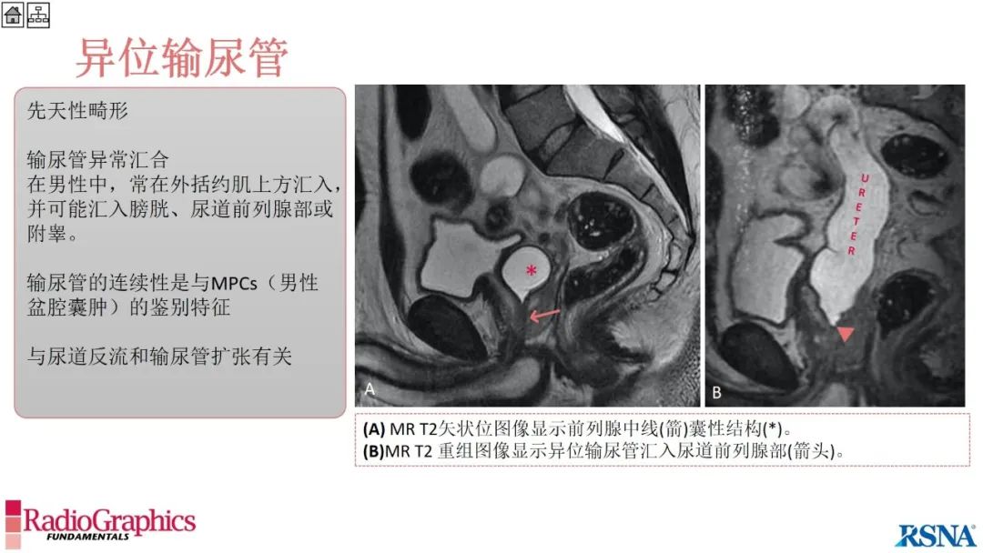 影像PPT - 【PPT】男性盆腔囊肿的影像诊断方法-96