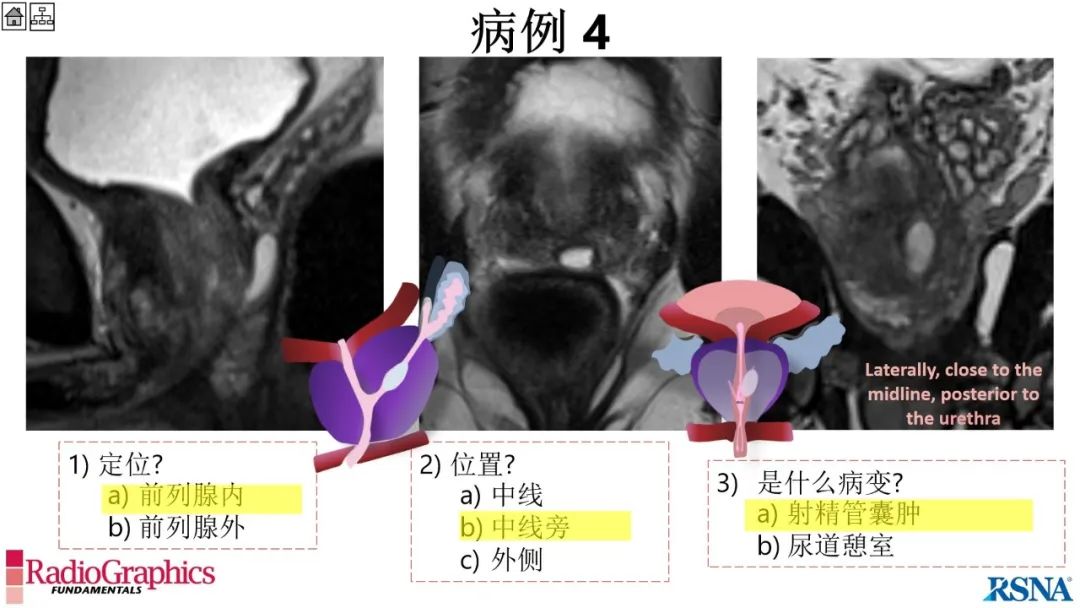 影像PPT - 【PPT】男性盆腔囊肿的影像诊断方法-52